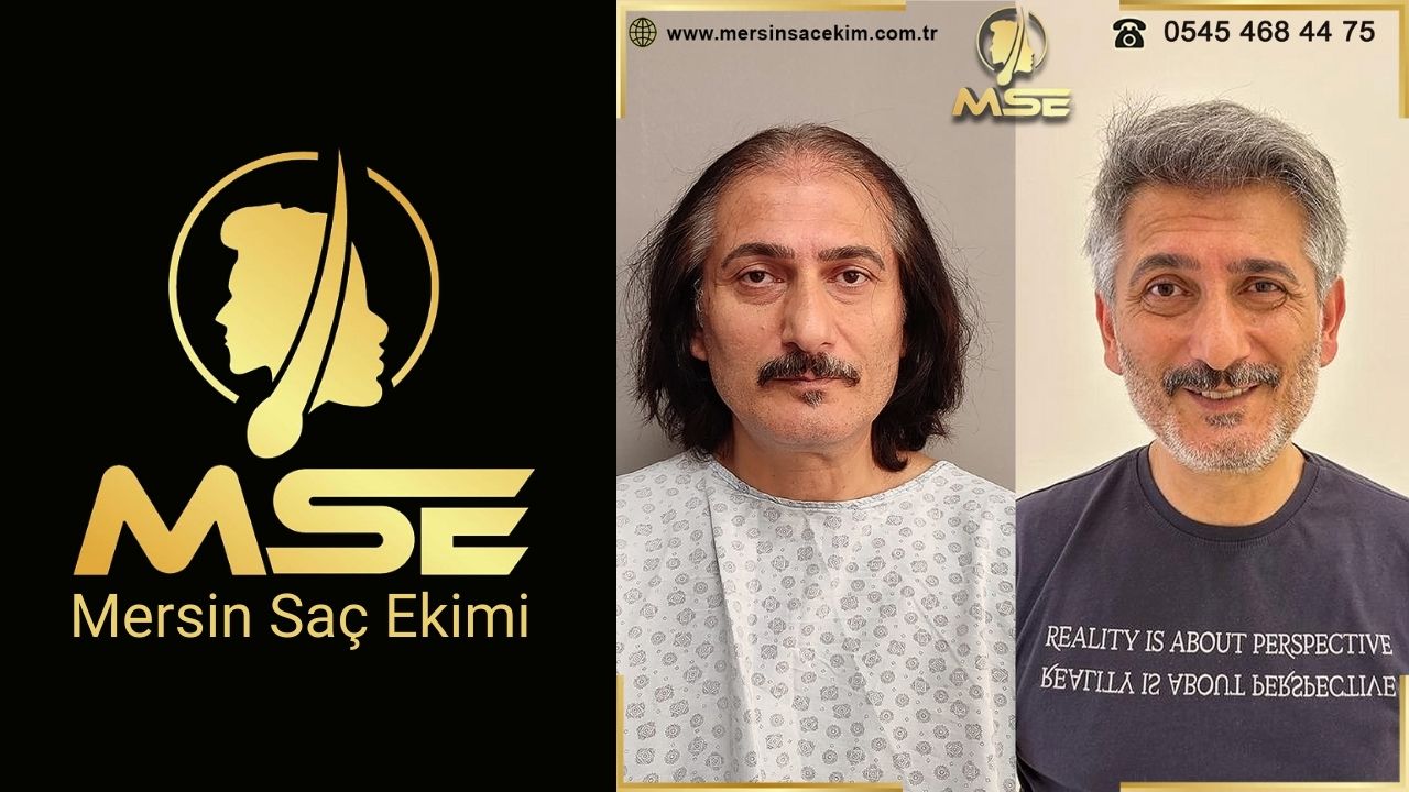 Mersin Saç Ekimi